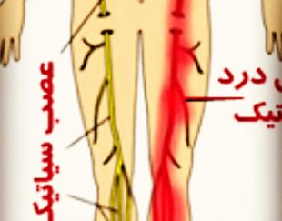 کمر و پا درد و سیاتیک، گردن و دست درد