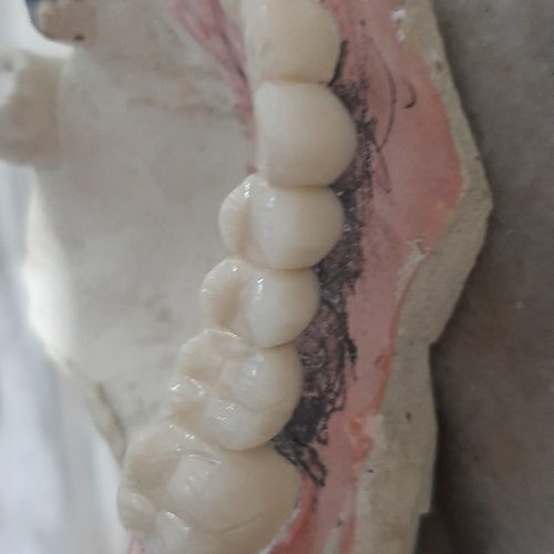 ساخت پروتز دندان متحرک و ثابت