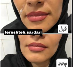 فروش ژل وفیلر ونخ لیفت و انجام خدمات زیبایی در شیراز و تهران
