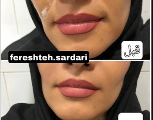 فروش ژل وفیلر ونخ لیفت و انجام خدمات زیبایی در شیراز و تهران