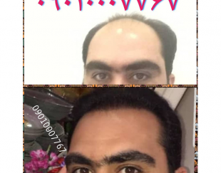 کاشت تخصصی مو ،ابرو،ریش در تهران