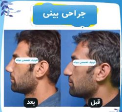 جراحی بینی و کاشت مو ابرو در جشنواره با هزینه عالی  در تهران