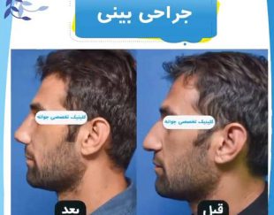 جراحی بینی و کاشت مو ابرو در جشنواره با هزینه عالی  در تهران