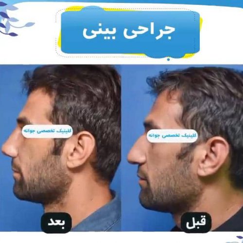 جراحی بینی و کاشت مو ابرو در جشنواره با هزینه عالی  در تهران