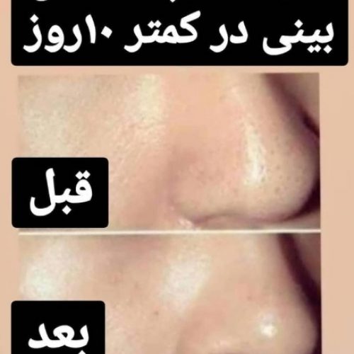 ماسک کوچک کننده بینی های گوشتی