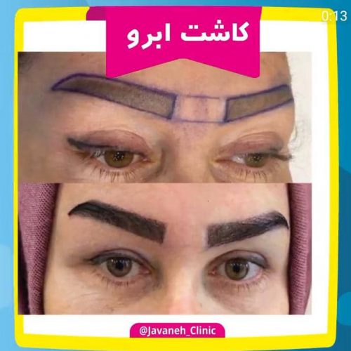 جراحی بینی و کاشت مو ابرو در جشنواره با هزینه عالی  در تهران