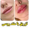 ارائه خدمات تزریق ژل و بوتاکس در اصفهان