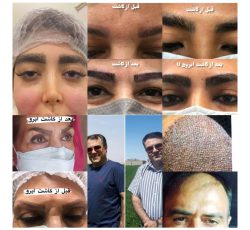 کاشت مو ، کاشت ابرو و تزریق چربی در تهران