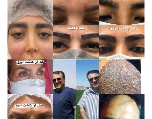 کاشت مو ، کاشت ابرو و تزریق چربی در تهران
