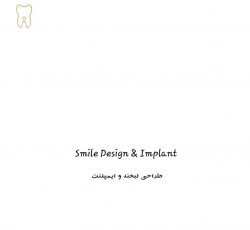 smile design&implant طراحی لبخند و نیر لمینت زیبایی و ایمپلنت در تهران – شهرک غرب