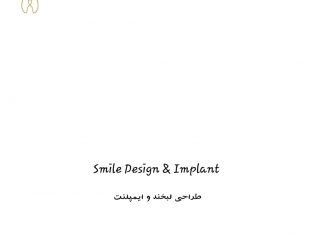 smile design&implant طراحی لبخند و نیر لمینت زیبایی و ایمپلنت در تهران – شهرک غرب