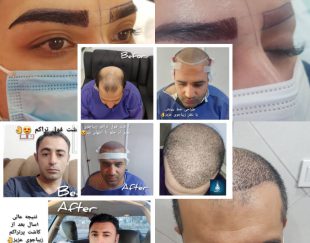 کاشت تخصصی مو و ابرو با تراکم بالا در تهران – ولیعصر