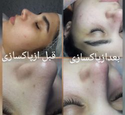 بهترین مرکز آموزش تخصصی فیشیال صورت و اسید تراپی در دزفول