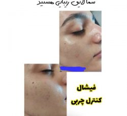 بهترین مرکز فیشیال ، پاکسازی و جوانسازی پوست صورت در شیراز