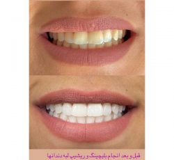 کلینیک دندانپزشکی عاج – بهترین مرکز خدمات دندانپزشکی ( ایمپلنت و بلیچینگ ونیر کامپوزیت ) در مهرشهر – کرج
