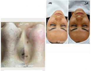 بهترین مرکز پاکسازی تخصصی پوست در اصفهان – فلاورجان