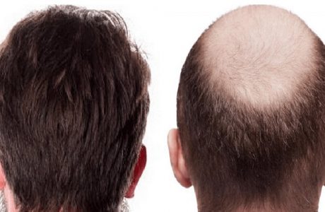 مزایای کاشت مو: بازگشت به ظاهر طبیعی، افزایش اعتماد به نفس و نتیجه دائمی