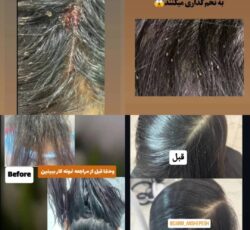 درمان شپش و تخم و رشک_ آمل